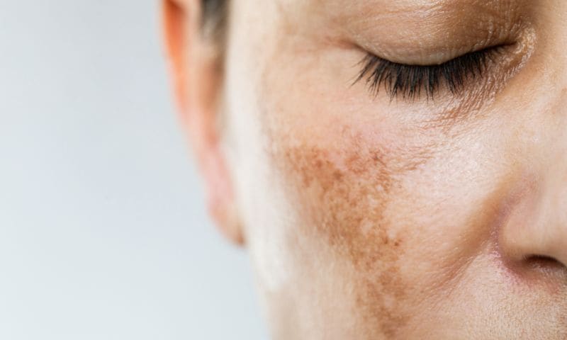 Hyperpigmentation